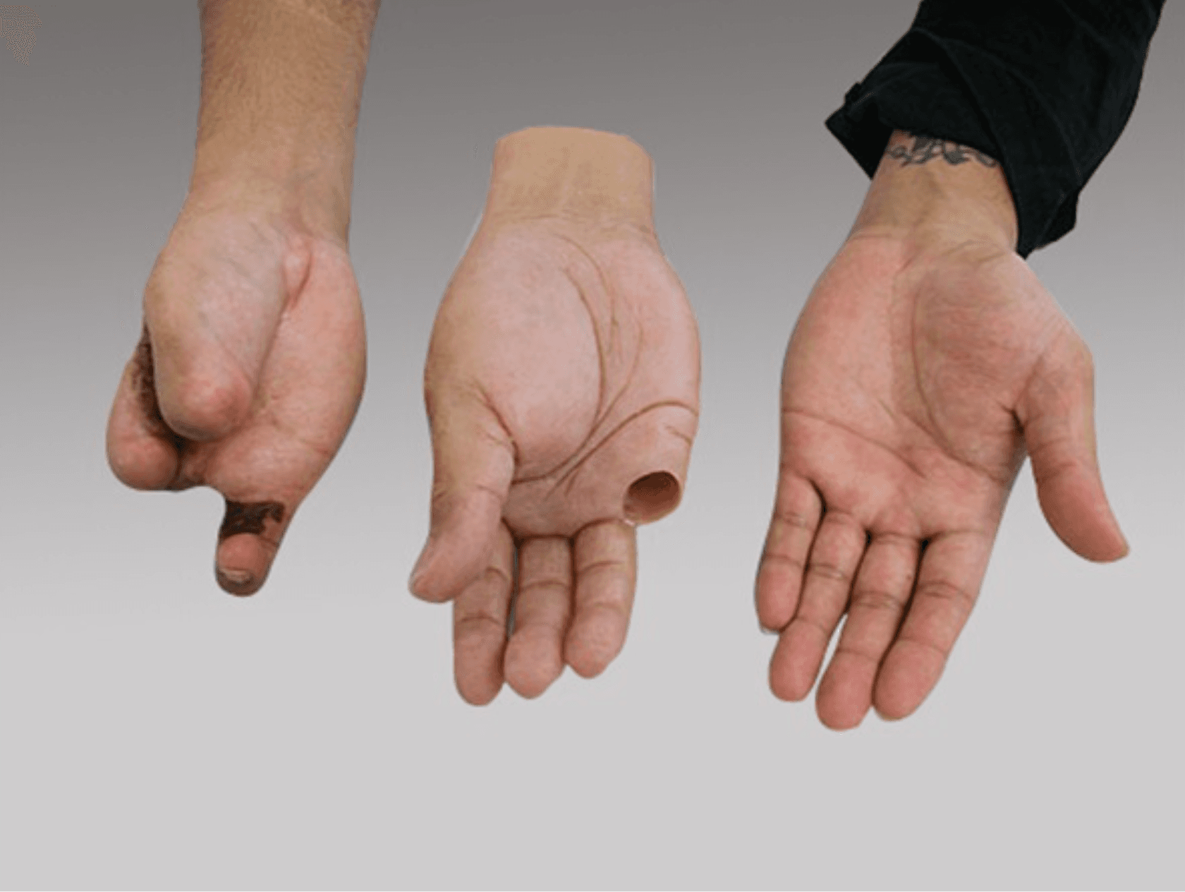 Profesyonel silikon protez çözümleri